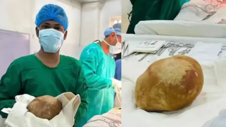 بوزن بيضة نعامة.. إزالة حصوة عملاقة من مثانة رجل