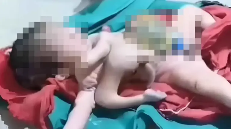 ولادة طفل بـ 8 أطراف.. تصدم الأطباء في الهند
